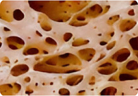 Маркер костной резорбции CTXI